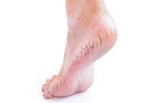 Cracked heel